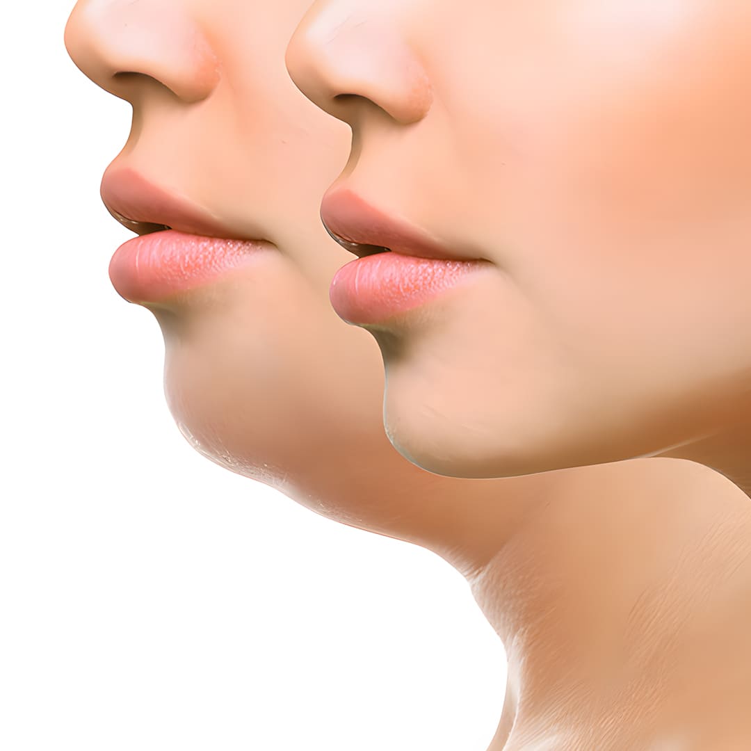 3 sesiones de lipopapada enzimática